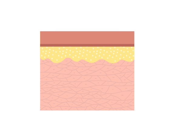 content_fraxel3
